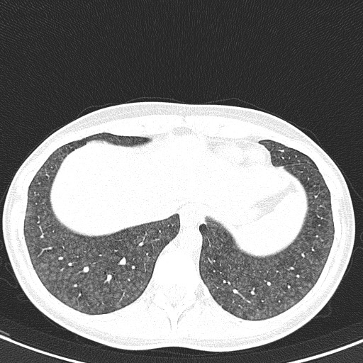File:Acute hypersensitivity pneumonitis (Radiopaedia 85293-100870 Axial lung window 100).jpg