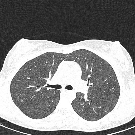 File:Acute hypersensitivity pneumonitis (Radiopaedia 85293-100870 Axial lung window 45).jpg