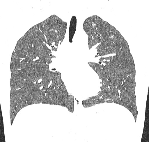 Acute hypersensitivity pneumonitis (Radiopaedia 85293-100870 Coronal lung window 64).jpg