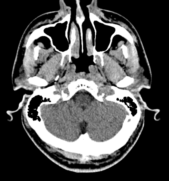 Acute ischemic stroke - posterior circulation territory (Radiopaedia 77670-89881 non-contrast 11).jpg