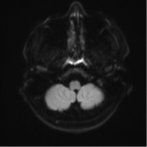 Acute left middle cerebral artery territory infarct with clot retrieval (Radiopaedia 47732-52433 Axial DWI 34).png