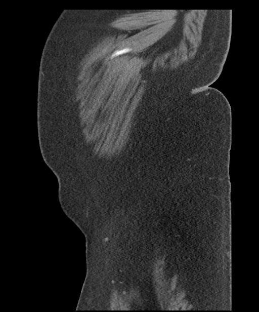 Acute mesenteric venous ischemia (Radiopaedia 46041-50383 Sagittal C+ portal venous phase 116).jpg
