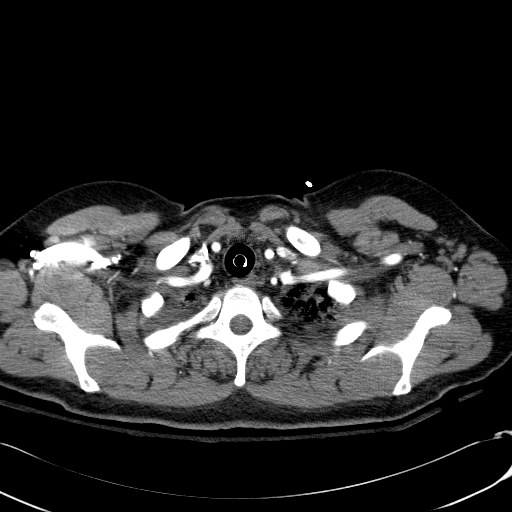 Acute myocardial infarction in CT (Radiopaedia 39947-42415 Axial C+ arterial phase 12).jpg