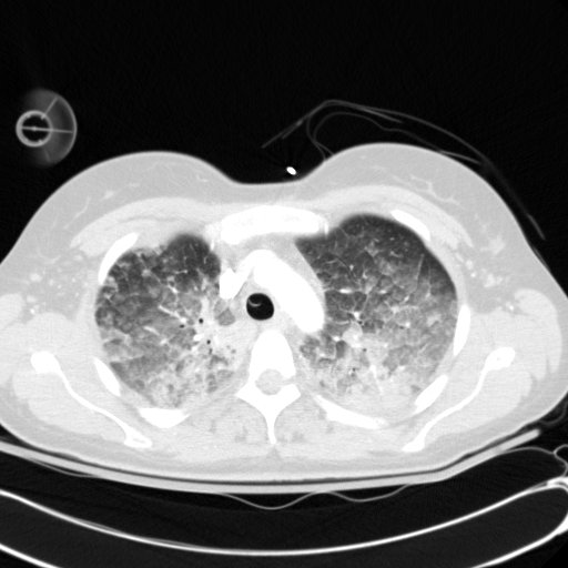 Acute myocardial infarction in CT (Radiopaedia 39947-42415 Axial lung window 30).jpg