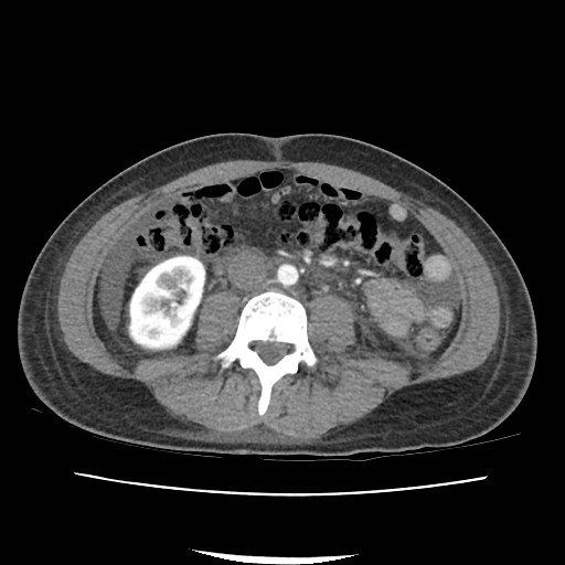File:Acute myocarditis (Radiopaedia 55988-62613 Axial C+ portal venous phase 41).jpg