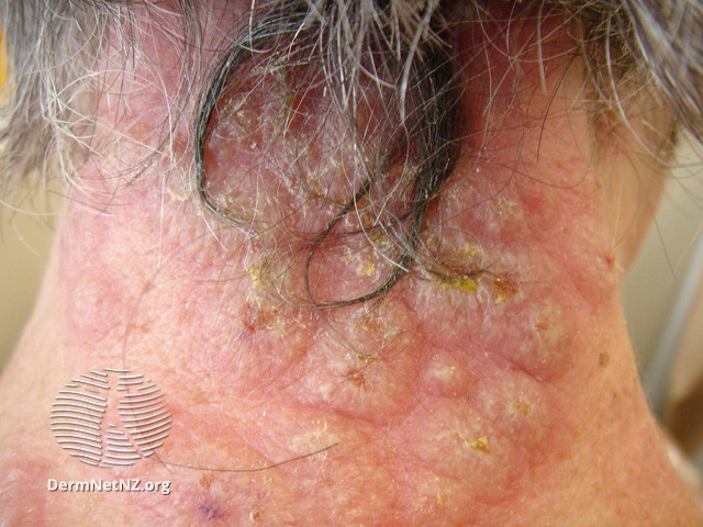 File:Acute neutrophilic dermatosis (DermNet NZ reactions-sweet6).jpg