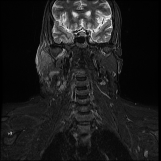 File:Acute otitis externa (Radiopaedia 57296-64236 Coronal STIR 11).jpg