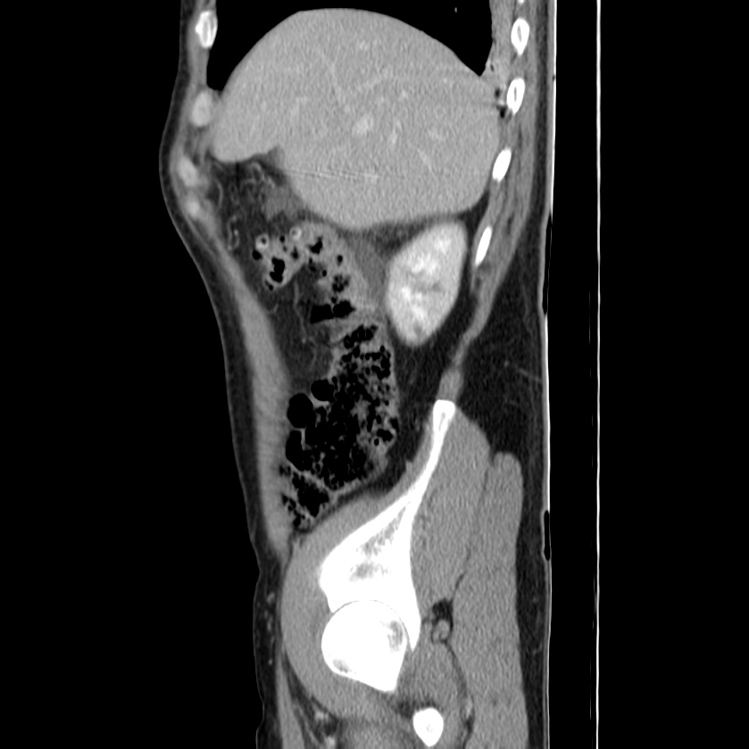 Acute pancreatitis (Radiopaedia 22572-22596 Sagittal C+ portal venous phase 12).jpg