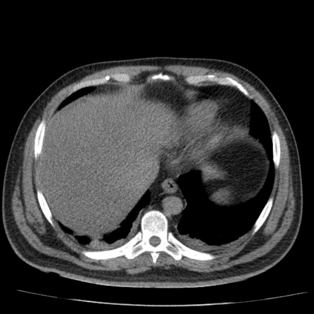 Acute pancreatitis (Radiopaedia 26663-26813 Axial non-contrast 16).jpg
