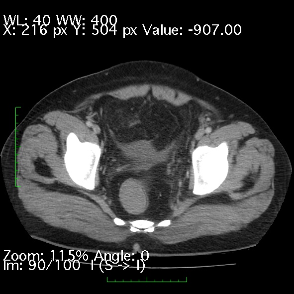 Acute pancreatitis (Radiopaedia 34043-35276 Axial C+ portal venous phase 90).jpg