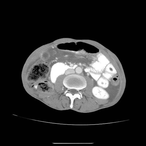 File:Acute pancreatitis (Radiopaedia 50213-55558 Axial C+ portal venous phase 26).jpg