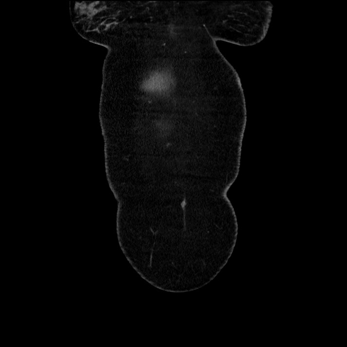 Acute pancreatitis (Radiopaedia 69236-79012 Coronal C+ portal venous phase 67).jpg
