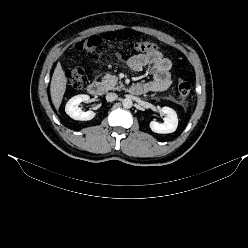Acute pancreatitis (Radiopaedia 87428-103757 Axial C+ portal venous phase 43).jpg