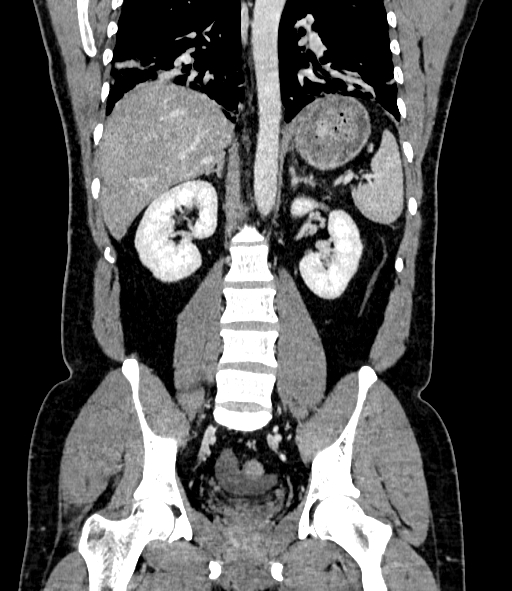 File:Acute pancreatitis (Radiopaedia 87428-103757 Coronal C+ portal venous phase 60).jpg