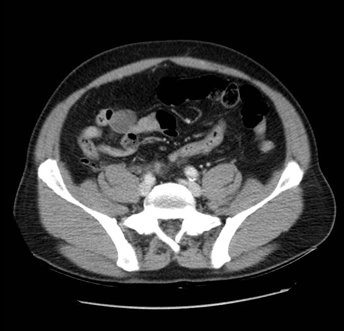 Acute pancreatitis - Balthazar E (Radiopaedia 23080-23110 Axial C+ portal venous phase 51).jpg