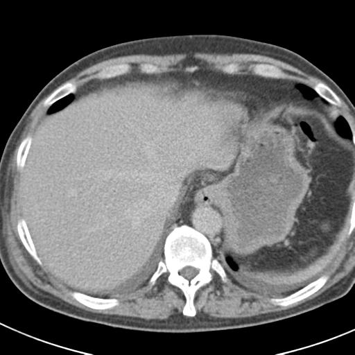 File:Acute pancreatitis and walled-off necrosis (Radiopaedia 29888-30403 Axial C+ delayed 15).jpg