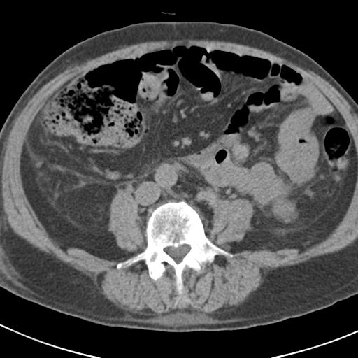 File:Acute pancreatitis and walled-off necrosis (Radiopaedia 29888-30403 Axial non-contrast 43).jpg