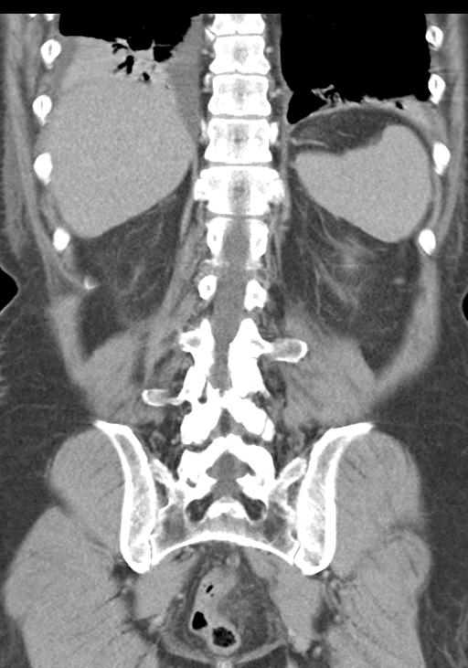 Acute pancreatitis and walled-off necrosis (Radiopaedia 29888-30403 E 44).jpg