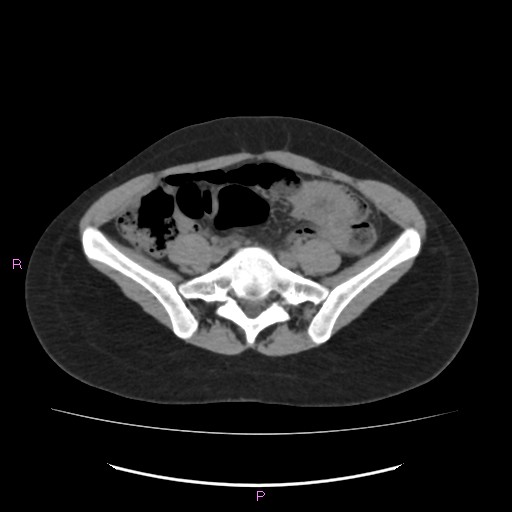 Acute pancreatitis secondary to stone at minor papilla and pancreatic divisum (Radiopaedia 76570-88333 Axial non-contrast 52).jpg