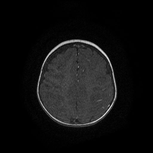 Acute phase of hemiconvulsion-hemiplegia epilepsy syndrome (Radiopaedia 29309-29745 Axial TOF angiography 4).jpg