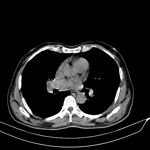 File:Acute pulmonary embolism (Radiopaedia 69510-79390 Axial non-contrast 20).jpg