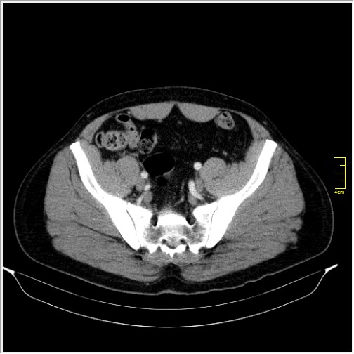Acute right sided diverticulitis (Radiopaedia 65249-74268 Axial C+ portal venous phase 63).JPG