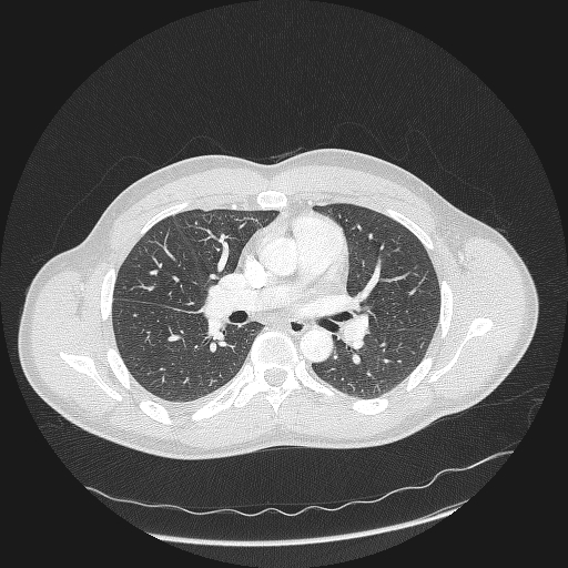 Acute segmental pulmonary emboli and pulmonary infarction (Radiopaedia 62264-70444 Axial lung window 85).jpg