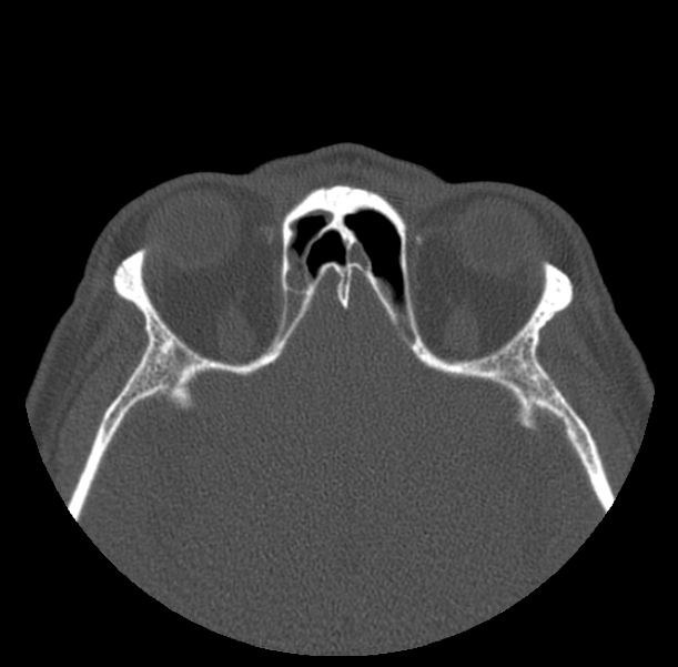Acute sinusitis (Radiopaedia 23161-23215 Axial bone window 57).jpg