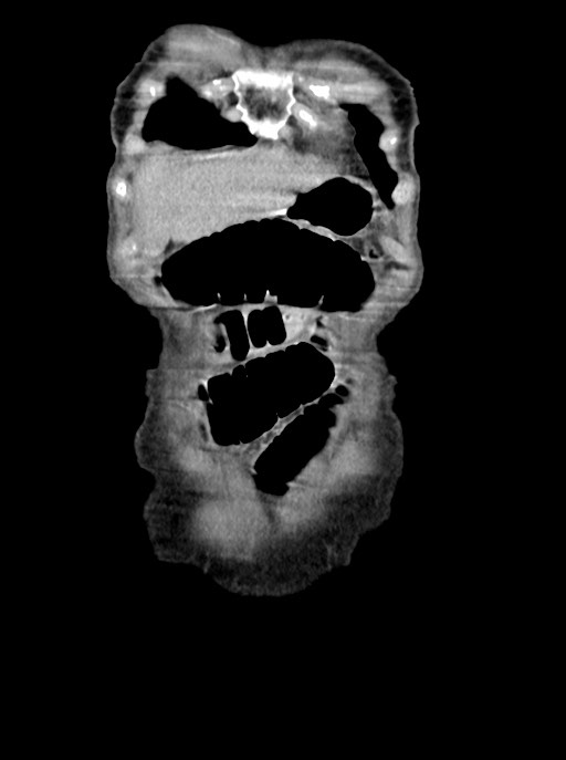 Acute small bowel (ileal) volvulus (Radiopaedia 71740-82139 Coronal C+ portal venous phase 14).jpg