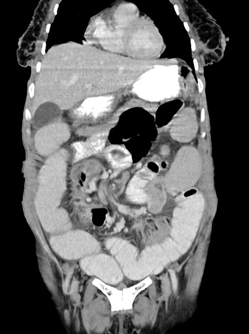 Acute small bowel (ileal) volvulus (Radiopaedia 71740-82139 Coronal C+ portal venous phase 38).jpg