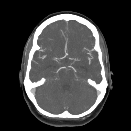 Acute subarachnoid hemorrhage and accessory anterior cerebral artery (Radiopaedia 69231-79009 D 26).jpg