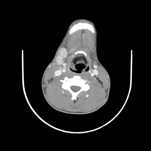 File:Acute submandibular sialadenitis secondary to ductal stone (Radiopaedia 27999-28267 Axial C+ delayed 30).jpg