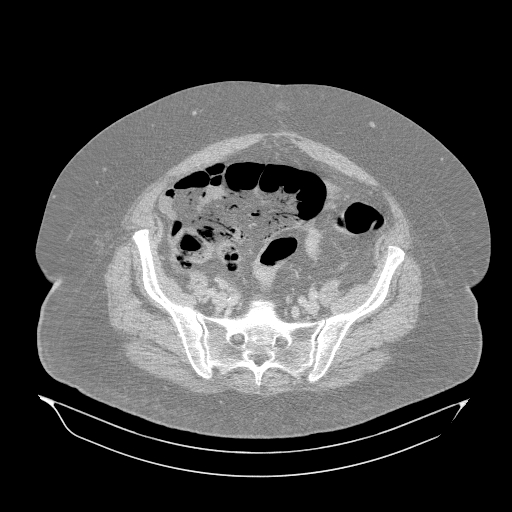 Acute superior mesenteric artery occlusion (Radiopaedia 51288-56960 Axial lung window 57).jpg