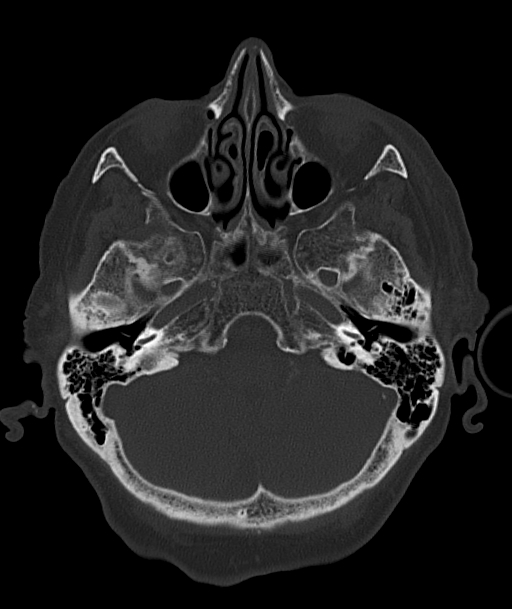 Acute traumatic subdural hematoma (Radiopaedia 82921-97257 Axial bone window 84).jpg