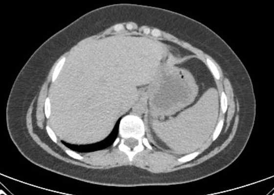 Acute unilateral nonhemorrhagic adrenal infarction (Radiopaedia 67560-76957 Axial non-contrast 7).jpg