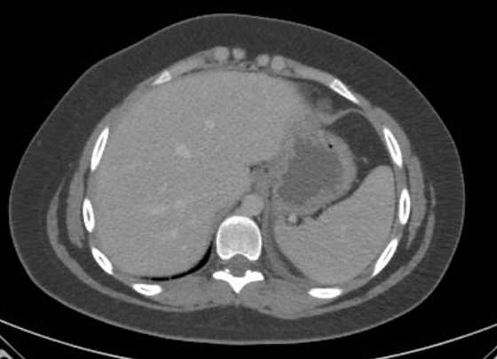 Acute unilateral nonhemorrhagic adrenal infarction (Radiopaedia 67560-76957 Axial renal parenchymal phase 2).jpg