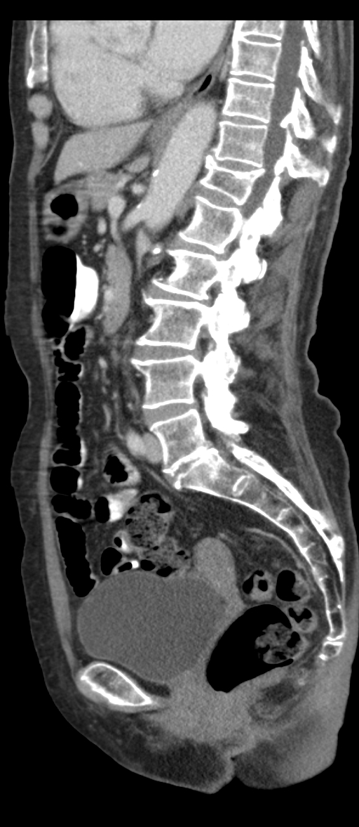 Adenocarcinoma of cecum (Radiopaedia 59222-66549 Sagittal C+ portal venous phase 41).jpg