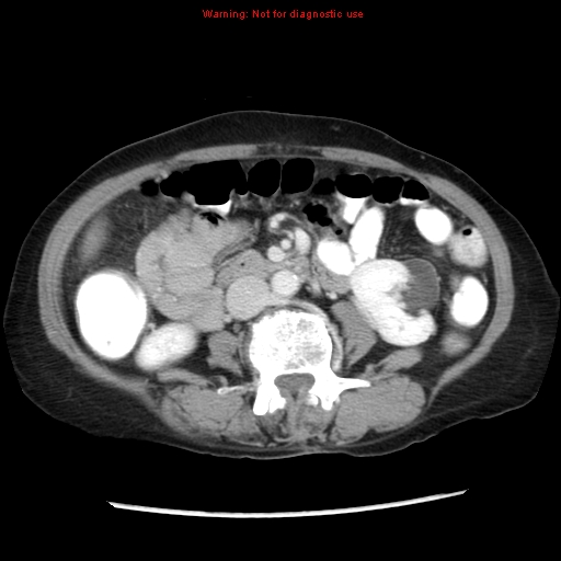 Adenocarcinoma of the colon (Radiopaedia 8191-9039 Axial liver window 37).jpg