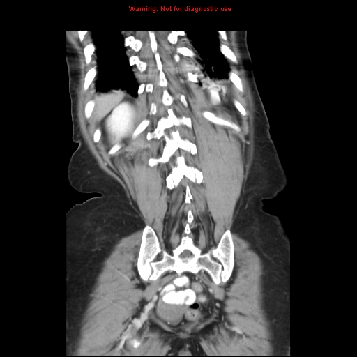 File:Adenocarcinoma of the colon (Radiopaedia 8191-9039 Coronal liver window 39).jpg