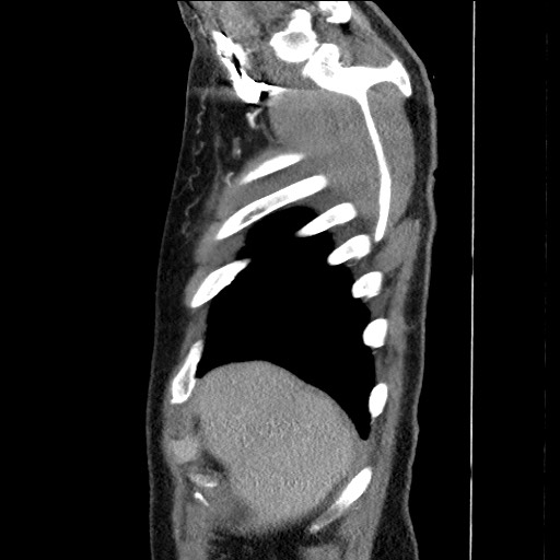 Adenocarcinoma of the lung (Radiopaedia 59871-67325 Sagittal C+ arterial phase 7).jpg