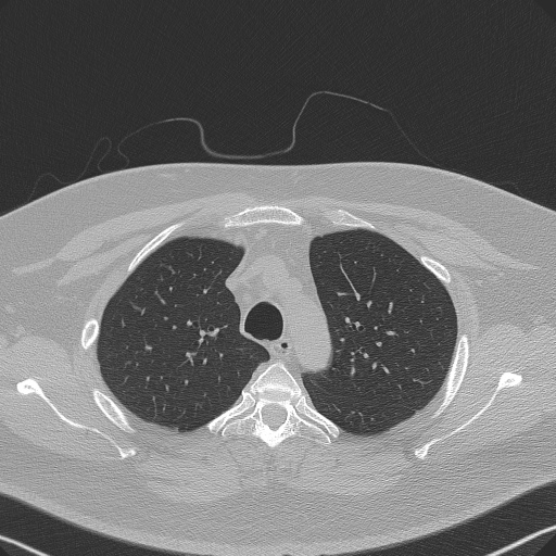 Adenoid cystic carcinoma of the trachea (Radiopaedia 49042-54137 Axial lung window 87).jpg
