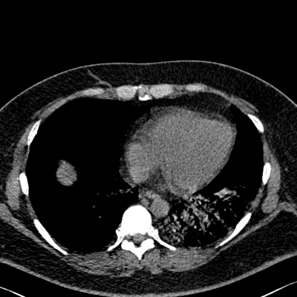 File:Adenoid cystic carcinoma of the trachea (Radiopaedia 49042-54137 Axial non-contrast 241).jpg