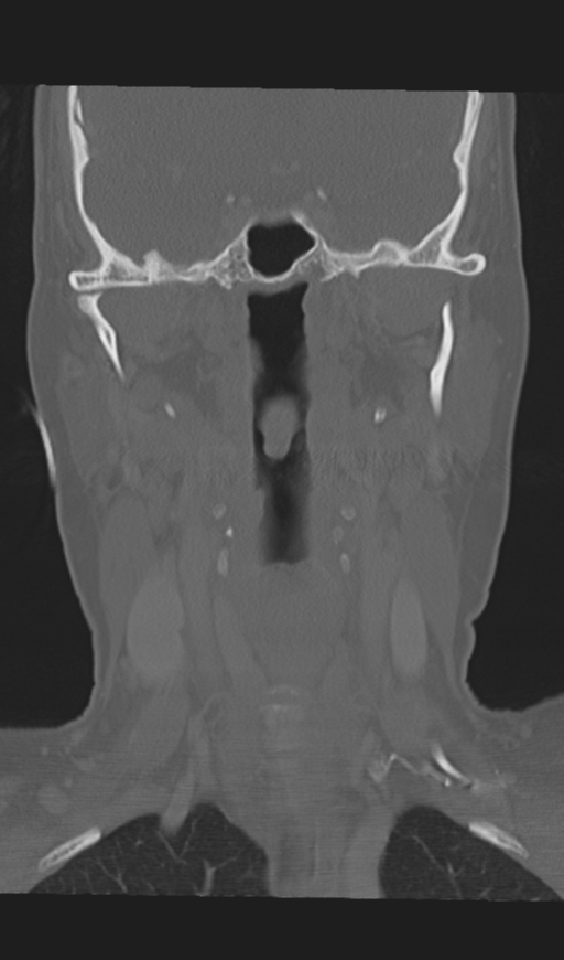 Adenoid cystic tumor of palate (Radiopaedia 46980-51518 Coronal bone window 35).png