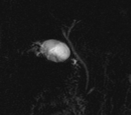 File:Adenomyomatosis of the gallbladder (Radiopaedia 15878-15523 Coronal MRCP 1).jpg