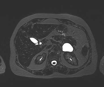 File:Adenomyomatosis of the gallbladder (Radiopaedia 50246-55587 Axial 64).png