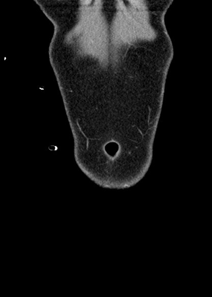 Adhesional small bowel obstruction (Radiopaedia 48397-53305 Coronal C+ portal venous phase 20).jpg