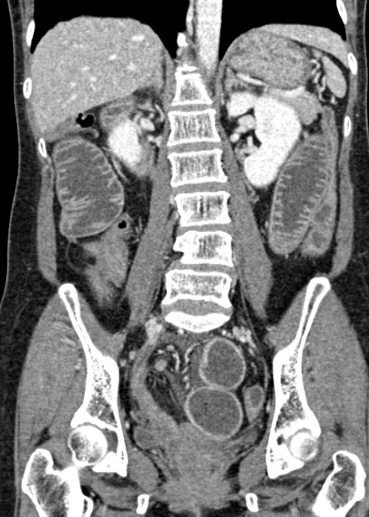 Adhesional small bowel obstruction (Radiopaedia 48397-53305 Coronal C+ portal venous phase 217).jpg