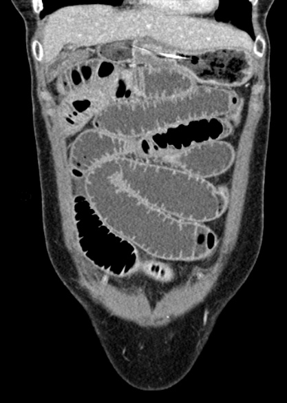Adhesional small bowel obstruction (Radiopaedia 48397-53305 Coronal C+ portal venous phase 81).jpg