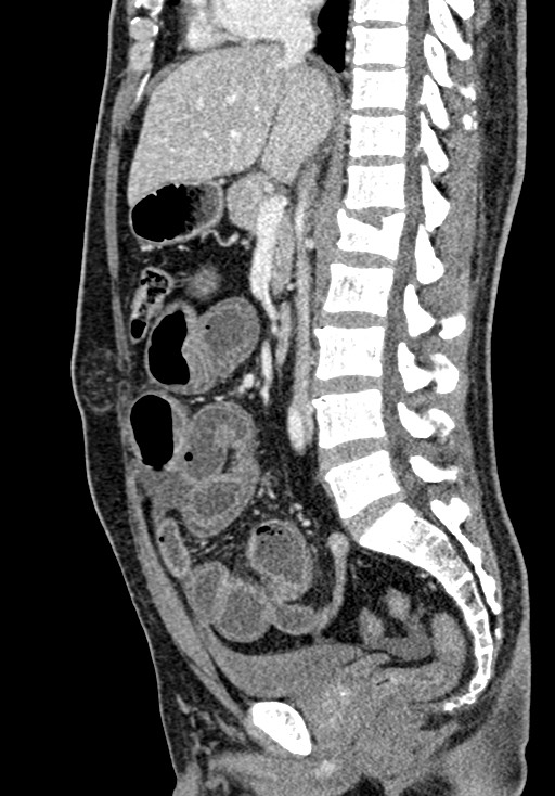 Adhesional small bowel obstruction (Radiopaedia 58900-66131 Sagittal C+ portal venous phase 120).jpg