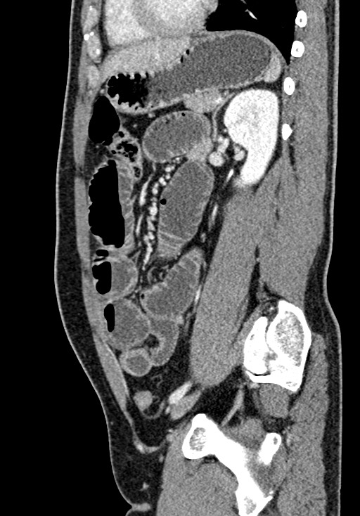 Adhesional small bowel obstruction (Radiopaedia 58900-66131 Sagittal C+ portal venous phase 163).jpg